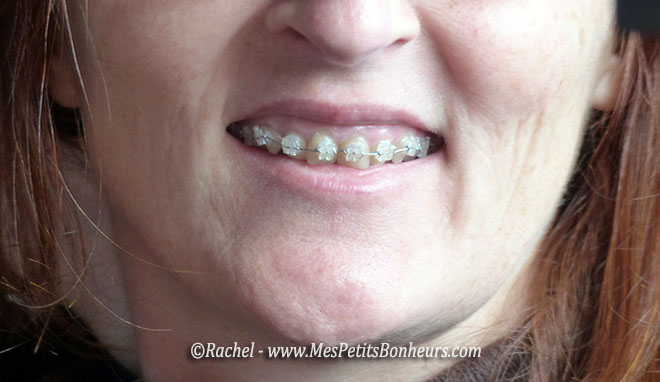 appareil dentaire orthodontie adulte